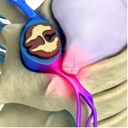 What conditions does spinal decompression treat as seen on GFChiro.com